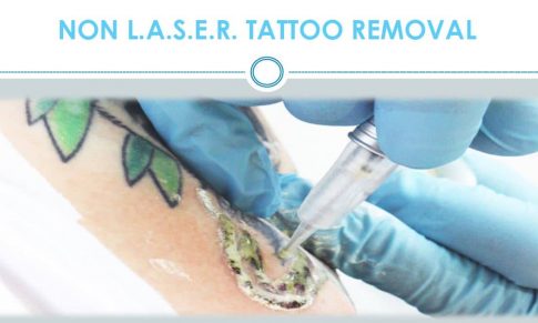 Indepartarea tatuajelor prin metoda chimica